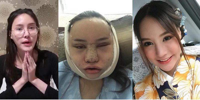 Seorang Gadis Thailand Bagi Foto Transformasi Wajahnya jadi Cantik