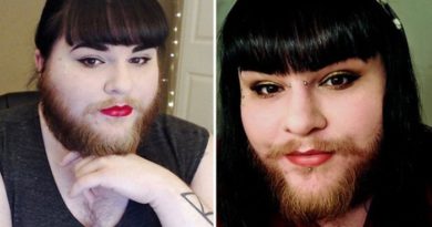 Wanita ini Awalnya Risih Akibat Kelainan Rambut di Wajah, Kini Hidupnya Berubah