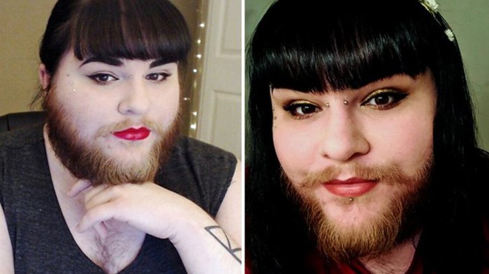 Wanita ini Awalnya Risih Akibat Kelainan Rambut di Wajah, Kini Hidupnya Berubah