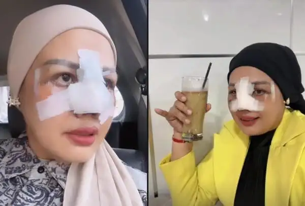 Elly Sugigi Rela Bayar Rp65 Juta untuk Operasi Hidung dan Mata